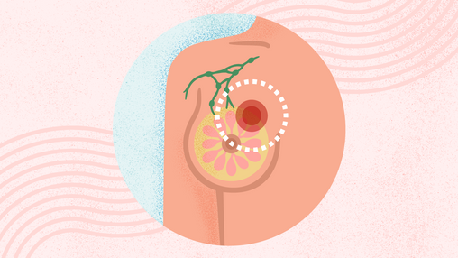 उत्तराखंड में स्तन कैंसर जांच को नई रफ्तार — पौड़ी-टिहरी में हफ्ते में दो बार स्क्रीनिंग शिविर